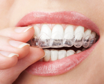 Orthodontic Retainer